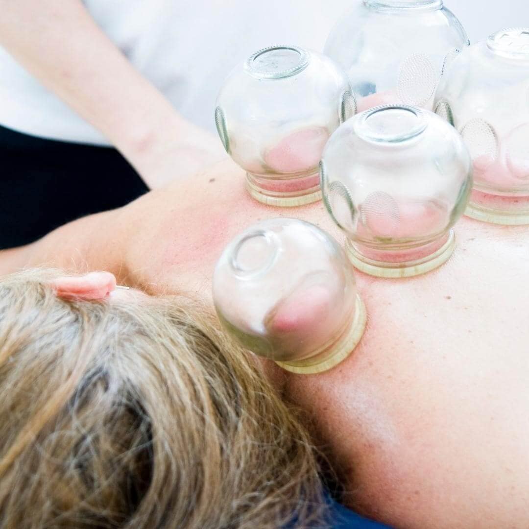Photo of woman getting a Fort Worth Cupping Massage